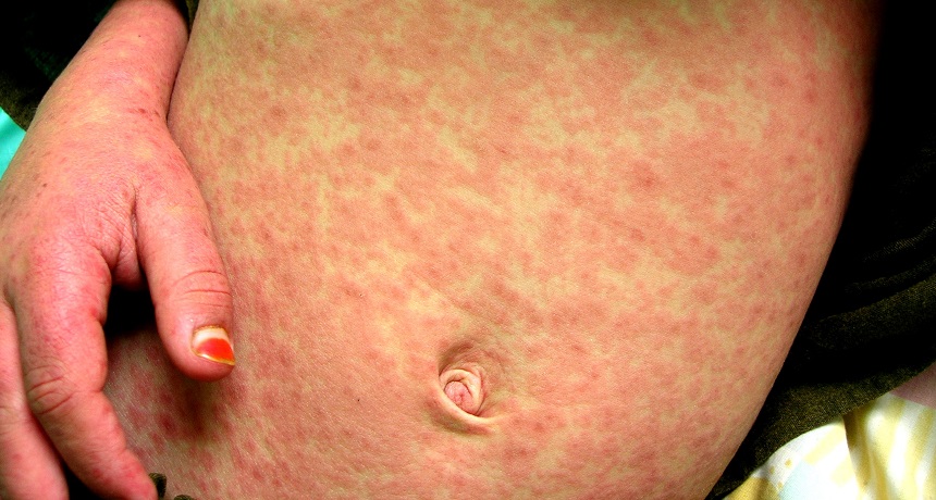 measles rash